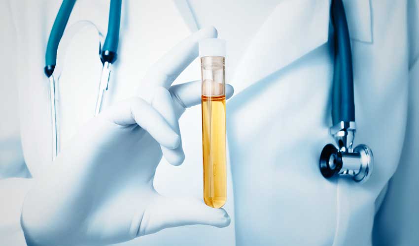 Dark Urine Dark Urine